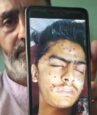 Kashmiri teen dies of pellet, tear gas shell wounds