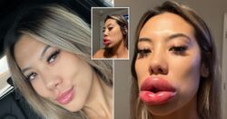 Woman’s allergic reaction to filler makes her lips balloon to three times their size