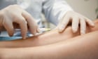 Scars and ulcers among risks from boom in beauticians treating varicose veins