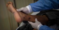 Monkeypox given new name after people called it ‘racist’