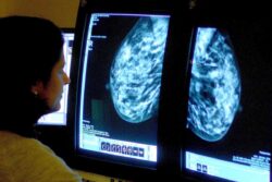 Radiotherapy ‘does not improve breast cancer survival after 30 years’