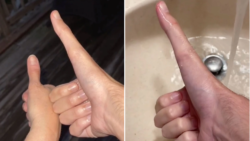 Man’s freakishly long five-incher takes him to thumb war victory