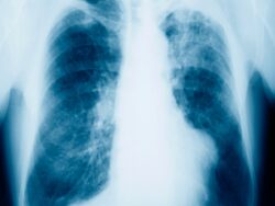 Mesothelioma: Signs and symptoms of asbestos cancer