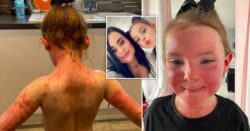 Mum warns parents of Strep A symptom that looks like sunburn