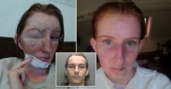 Mum’s freckles ‘melted off’ after brother-in-law attacked her with boiling water