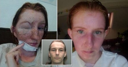 Mum’s freckles ‘melted off’ after brother-in-law attacked her with boiling water