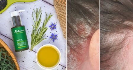 Shoppers hail this rosemary oil a ‘miracle’ for psoriasis and thinning hair: ‘Wish I had found this years ago’