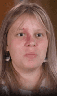 Woman’s birthmark bleeds down her face ‘almost daily’ like a ‘constant dripping faucet’