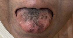 Woman’s tongue turns ‘black and hairy’ in bizarre reaction to antibiotics