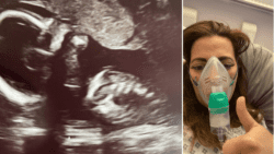 Unborn baby wriggling away in the womb after surgery to treat spina bifida