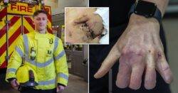 Firefighter’s crushed hand was saved by surgeons who sewed it into his stomach