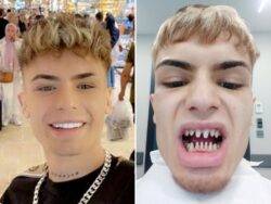 Model’s warning after £300 Turkey teeth surgery leaves him looking ‘like a shark’