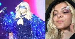 Bebe Rexha wears massive goggles on stage after being injured on stage by fan