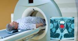 Simple 10-minute MRI scan could be used to screen men for prostate cancer