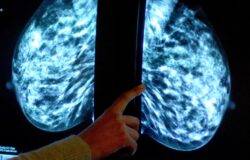 NHS considers using AI to spot breast cancer