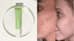 Shoppers say the new zit-busting product can clear spots ‘in just 24 hours’