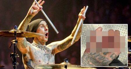 Travis Barker’s hand is a bloody mess in gory photos after Blink 182 show