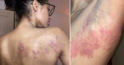‘I wanted to rip my skin off after my shingles took over my body’