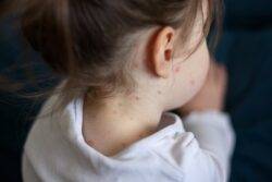 Measles outbreak spreads to another city after students contract disease