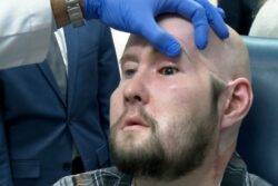 World’s first-ever eye transplant carried out on man who survived horror accident