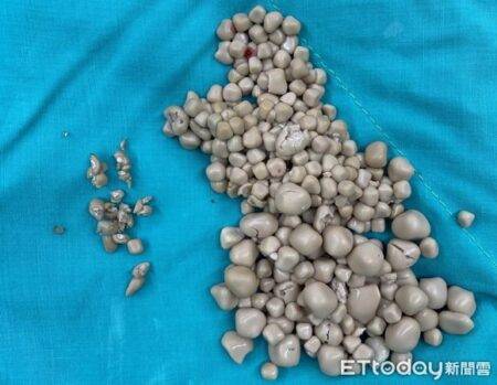 Woman, 20, who ‘doesn’t enjoy drinking water’ has 300 kidney stones removed