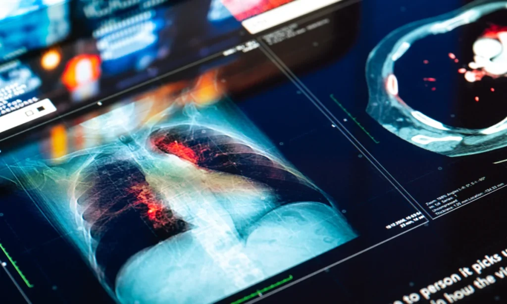 World-first urine test ‘detects lung cancer’ World-first urine test ‘detects lung cancer’