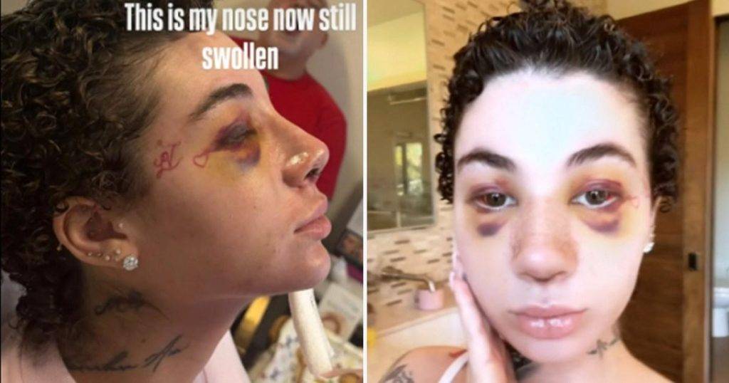Controversial US rapper unrecognisable with swollen face from nose job after cancer diagnosis Controversial US rapper unrecognisable with swollen face from nose job after cancer diagnosis