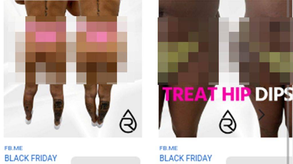 Brazilian butt lift adverts banned in the UK – here’s why