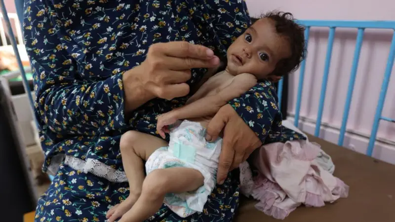 Rama Abu Aya, aged 5-months, is malnourished, according to medics at the Nasser Hospital in Khan Younis