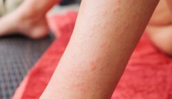Silent Celiac: The Hidden Side Of Gluten Sensitivity