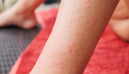 Silent Celiac: The Hidden Side Of Gluten Sensitivity